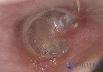 Stapedectomy Case