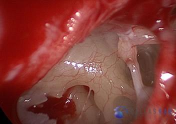 Stapedectomy Case