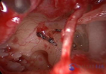 Stapedectomy Case