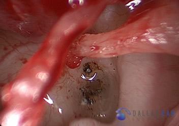 Stapedectomy Case