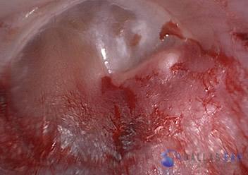 Stapedectomy Case