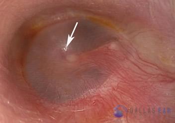 Glomus Tympanicum Tumors | Dallas Ear Institute