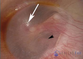 Glomus Tympanicum Tumors | Dallas Ear Institute