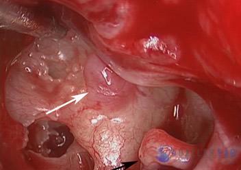 Glomus Tympanicum Tumors | Dallas Ear Institute
