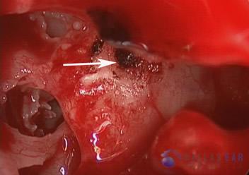 Glomus Tympanicum Tumors | Dallas Ear Institute