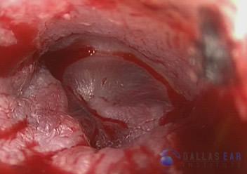 Glomus Tympanicum Tumors | Dallas Ear Institute