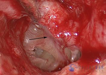 Glomus Tympanicum Tumors | Dallas Ear Institute