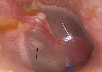Glomus Tympanicum Tumors | Dallas Ear Institute