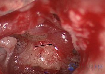 Glomus Tympanicum Tumors | Dallas Ear Institute