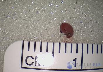 Glomus Tympanicum Tumors | Dallas Ear Institute