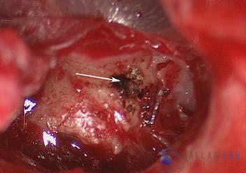 Glomus Tympanicum Tumors | Dallas Ear Institute