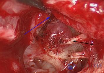 Glomus Tympanicum Tumors | Dallas Ear Institute