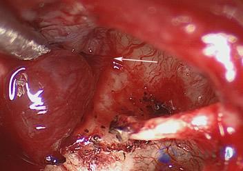 Glomus Tympanicum Tumors | Dallas Ear Institute