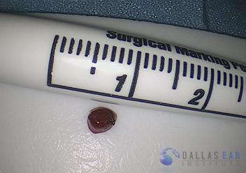 Glomus Tympanicum Tumors | Dallas Ear Institute