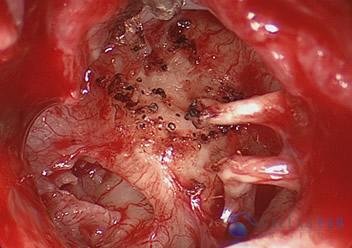 Glomus Tympanicum Tumors | Dallas Ear Institute