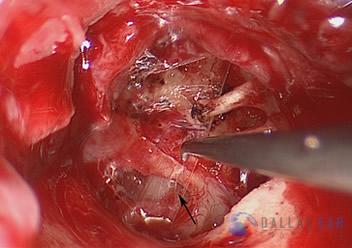 Glomus Tympanicum Tumors | Dallas Ear Institute