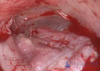 Glomus Tympanicum Tumors | Dallas Ear Institute