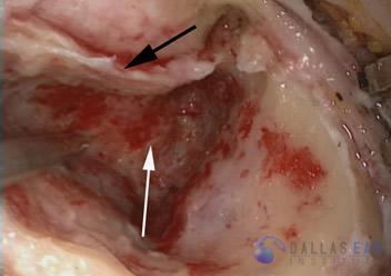 Labyrinthectomy