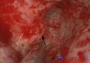 Labyrinthectomy