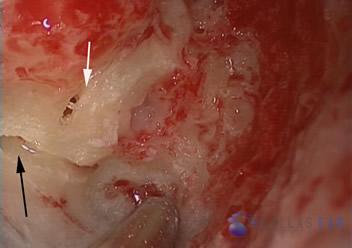 Labyrinthectomy