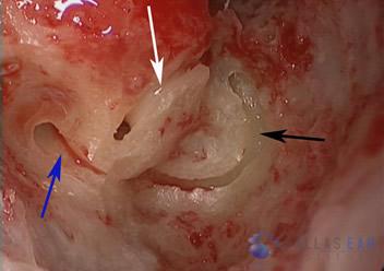 Labyrinthectomy