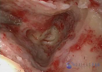 Labyrinthectomy