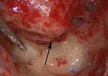 Labyrinthectomy