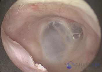 Surgical Hearing Correction Cases