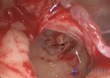 Surgical Hearing Correction Cases