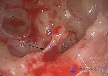 Surgical Hearing Correction Cases