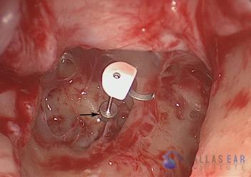 Surgical Hearing Correction Cases