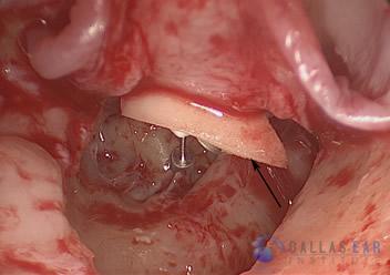 Surgical Hearing Correction Cases