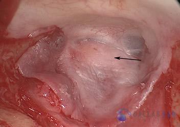 Surgical Hearing Correction Cases