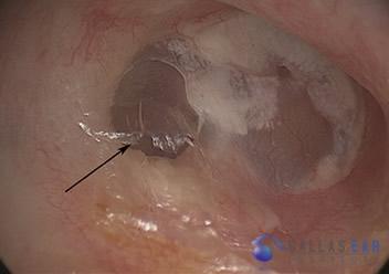 Surgical Hearing Correction Cases
