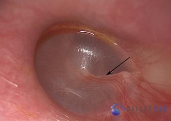 Surgical Hearing Correction Cases