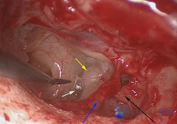 Surgical Hearing Correction Cases