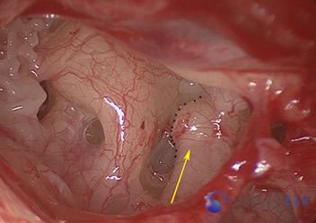 Surgical Hearing Correction Cases