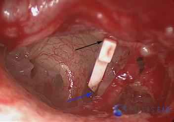 Surgical Hearing Correction Cases