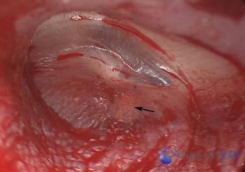 Surgical Hearing Correction Cases