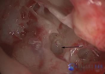 Surgical Hearing Correction Cases