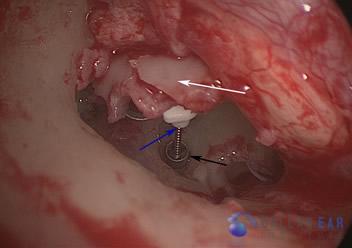 Surgical Hearing Correction Cases