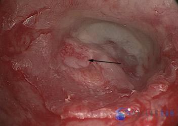 Surgical Hearing Correction Cases