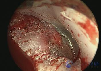 Temporal Bone Trauma Cases