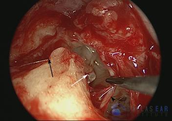 Temporal Bone Trauma Cases