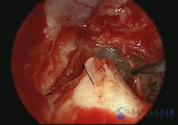 Temporal Bone Trauma Cases