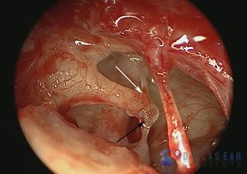 Temporal Bone Trauma Cases
