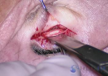 Temporal Bone Trauma Cases