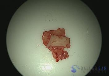 Temporal Bone Trauma Cases