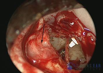 Temporal Bone Trauma Cases