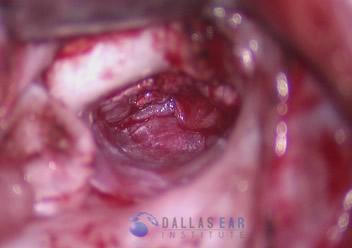 Tympanoplasty